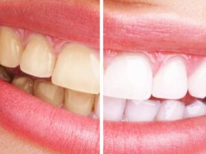 ¿Cómo cepillarse los dientes correctamente?