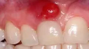 Abscesos Dentales