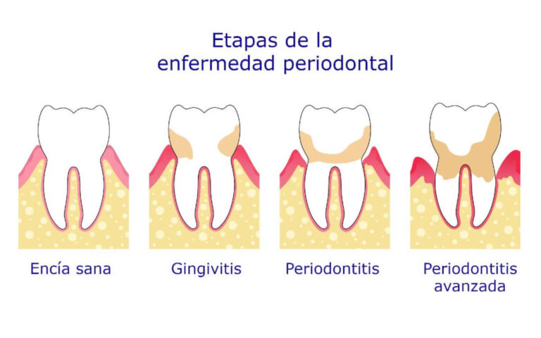 como-diferenciar-gingivitis-de-periodontitis