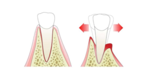 Movilidad Dental